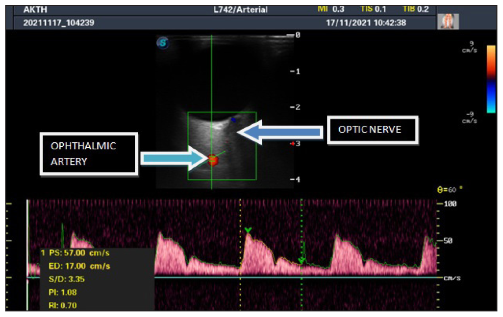 Triplex transverse ultrasonogram showing the color filled right ophthalmic artery (Arrow) and its spectral waveform. PS: Peak systolic, ED: End diastolic, RI: Resistive index, PI: Pulsatility index.