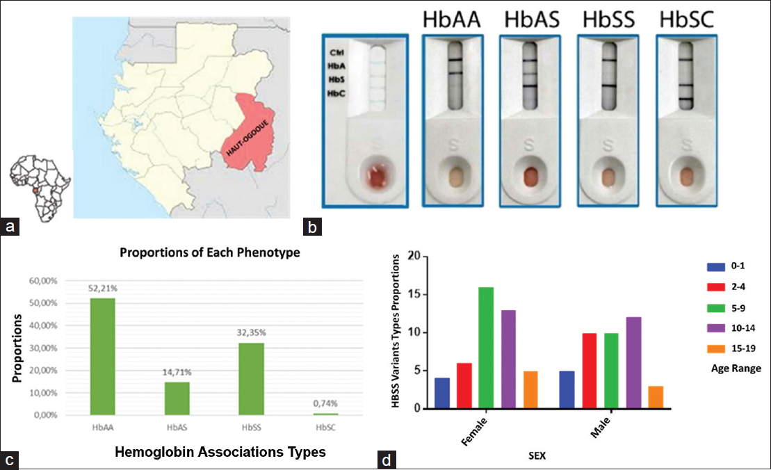 a) Map of Gabon showing the sampling area (Haut-Ogooué). b) Sickle SCAN® test device and results for common hemoglobin patterns. The Sickle SCAN® (BioMedomics, Inc., Research Triangle Park, NC, USA) device is based on lateral flow chromatographic qualitative immunoassay for rapid determination of the presence or absence of HbA, HbS, and HbC, thereby assisting in the diagnosis of the most common forms of SCD. c) Phenotypes identified by Sickle SCAN® testing of the general study population. d) Distribution of the HbSS phenotype according to sex and age group in the HbSS population.